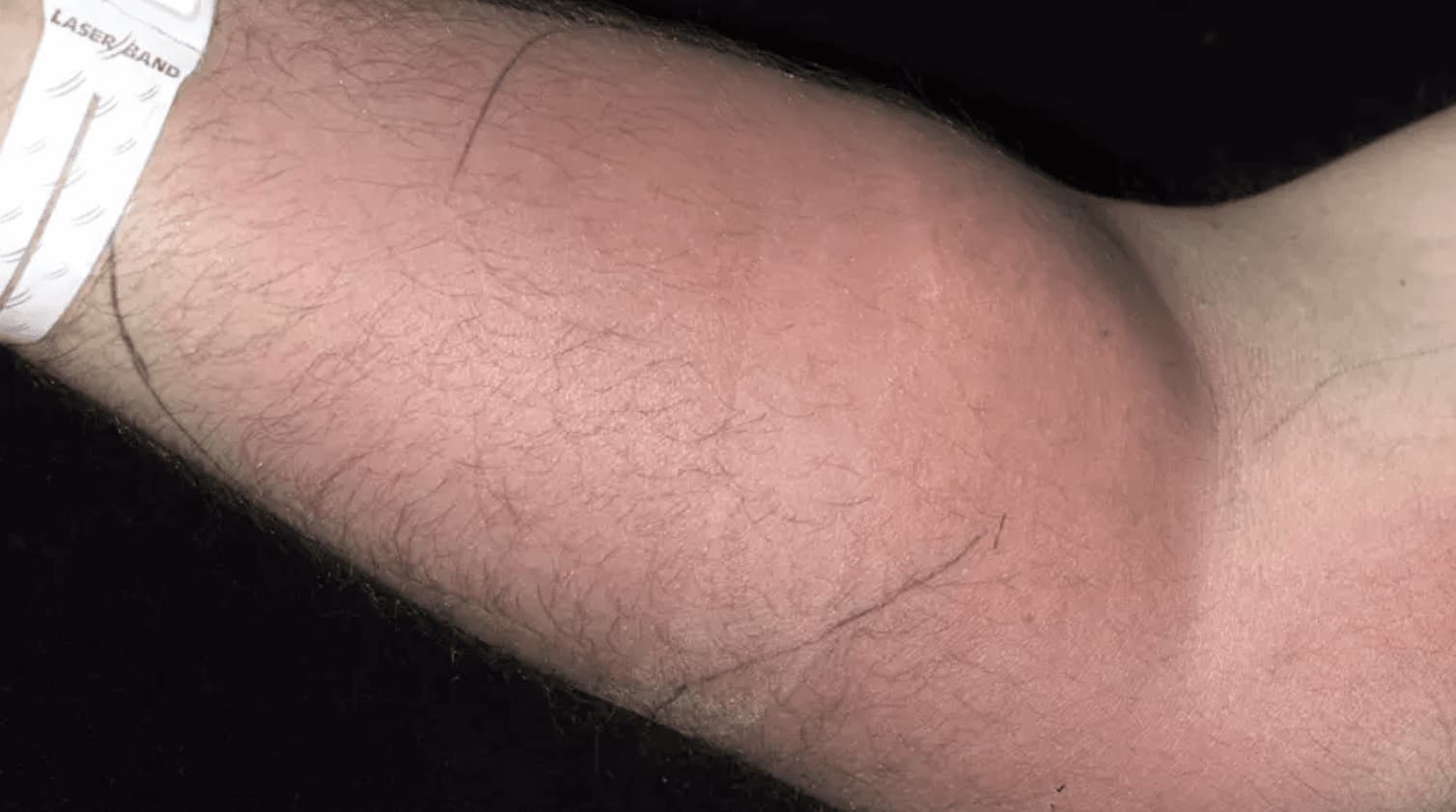 Neįprastas eksperimentas: vyras gydė nugaros skausmą savo spermos injekcijomis — baigėsi ligoninėje