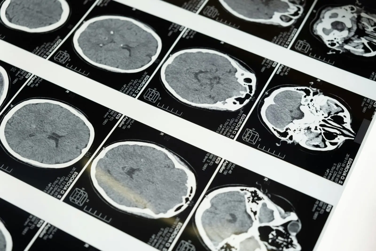 Trečiasis „Neuralink“ implantas sėkmingai veikia paciento smegenyse