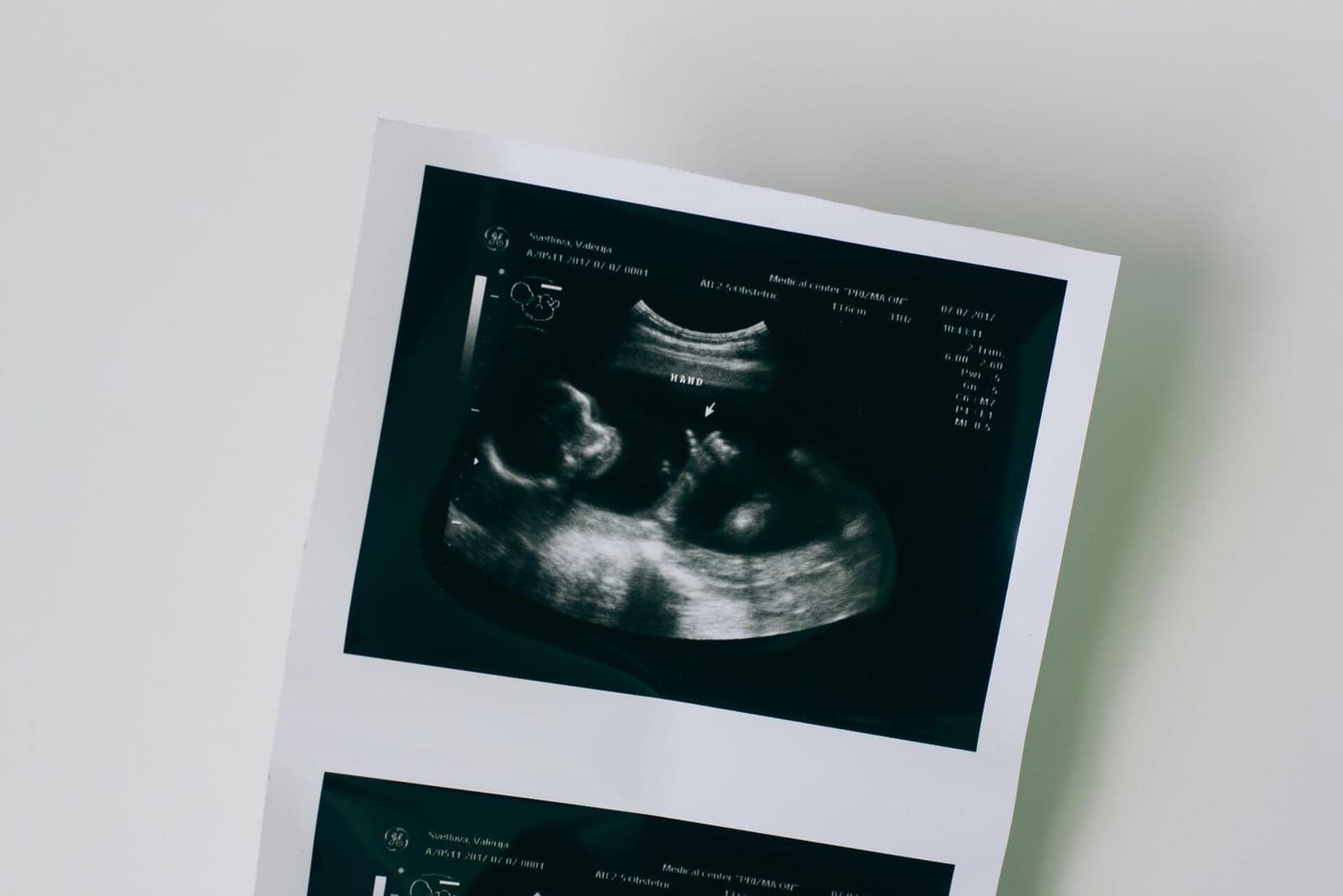 Britanijos parlamentas žengia link abortų dekriminalizavimo: sprendimas arti finišo