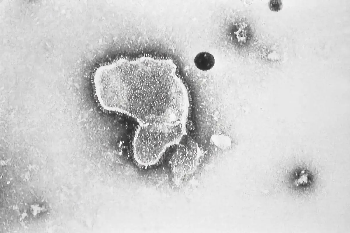 RSV (respiracinis sincitinis virusas): simptomai, pavojus kūdikiams ir senjorams, apsaugos būdai