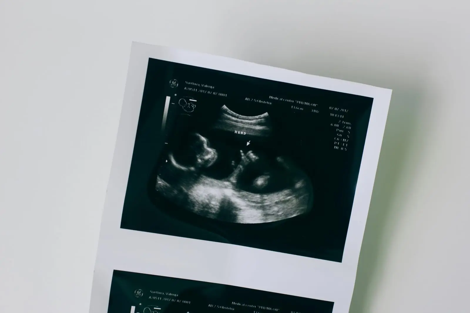 Pagalbinį apvaisinimą Lietuvoje galės gauti ir nesusituokusios poros?
