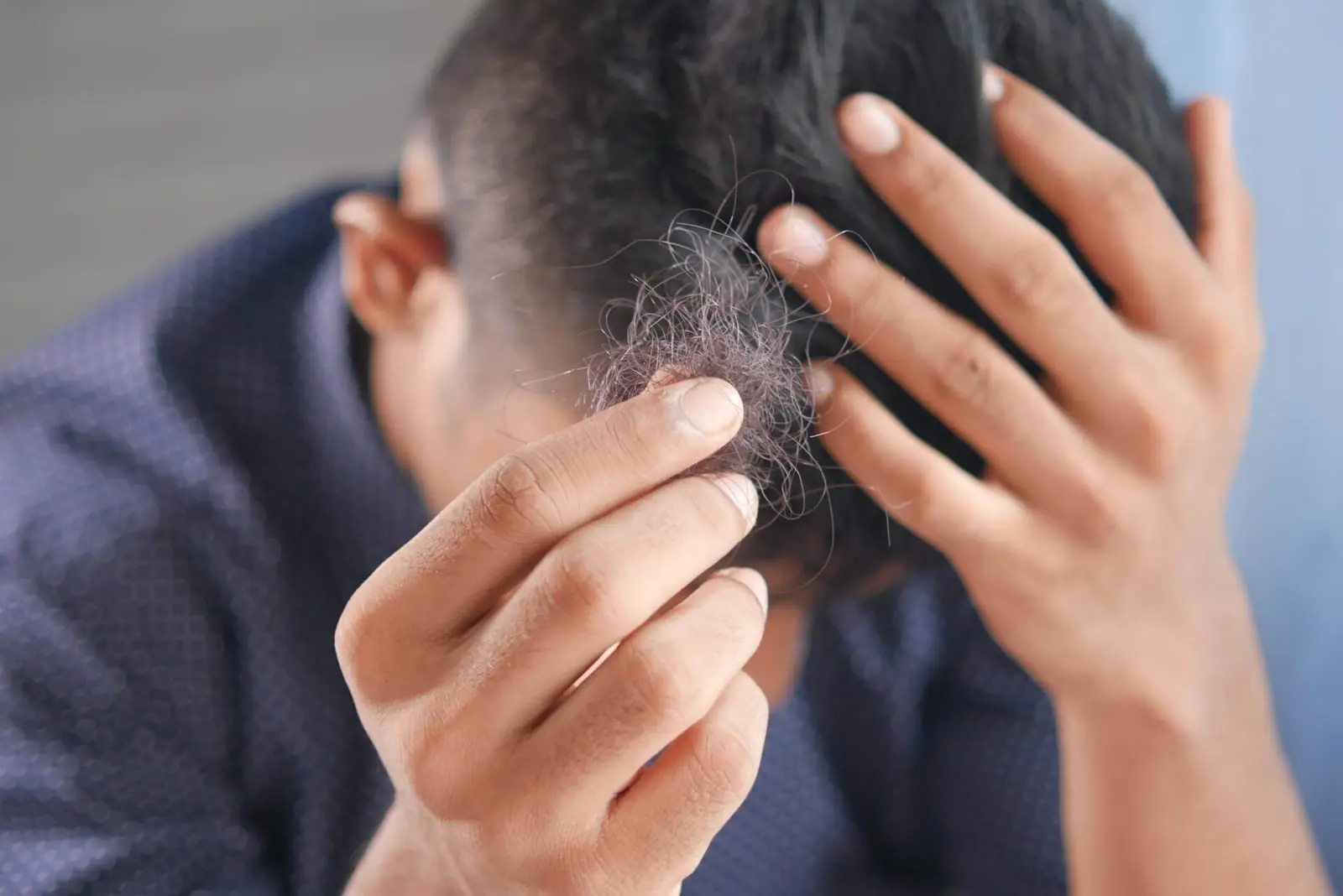 Kas yra alopecija? Milijonams moterų pasaulyje tai kelia didelių rūpesčių
